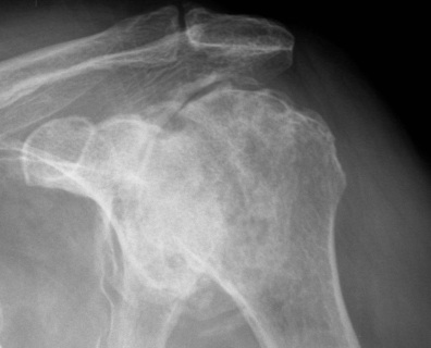 AVN Shoulder Xray